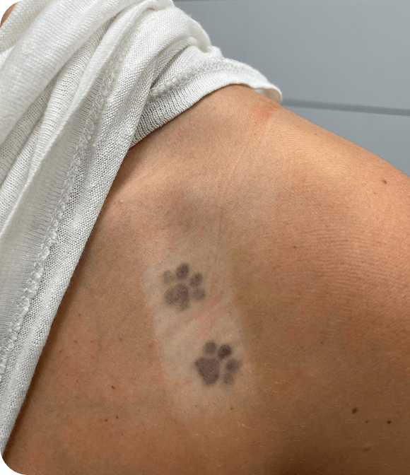 En el hombro de una persona se ven dos tatuajes de huellas negras bajo un paño blanco, lo que pone de relieve el talento artístico de TALLA S., de NOBLE ART OFFICIAL COORP.