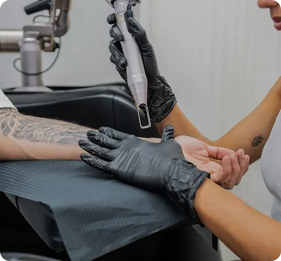 Tattoo removal on the arm